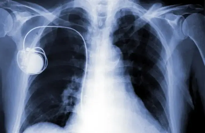 Implante de marcapasos uni y bicameral